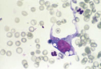 However, in some cats with hepatic lymphoma, the neoplastic cell population is composed of small, well-differentiated lymphocytes (Figure 15).