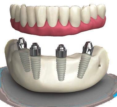Full Arch Immediate Load Courses with Live Surgical & Restorative Demonstration TeethXpress is a full-arch, immediate-load, clinical protocol and comprehensive business program that uses advanced