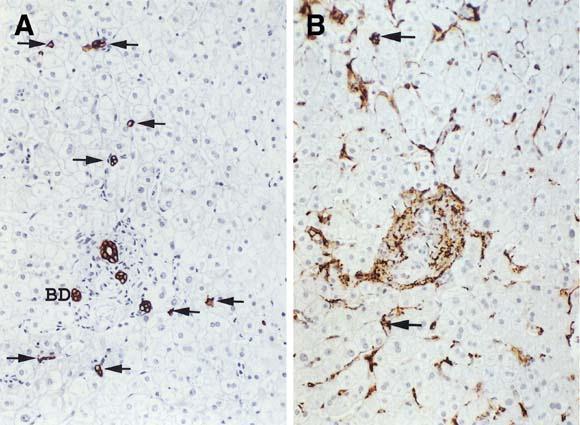 Biopsy from a patient with PBC. (A) Immunohistochemical staining for CK19 in a patient highlights CoH, which appear as clusters and strings of cuboidal cells within the hepatic lobule (arrows).