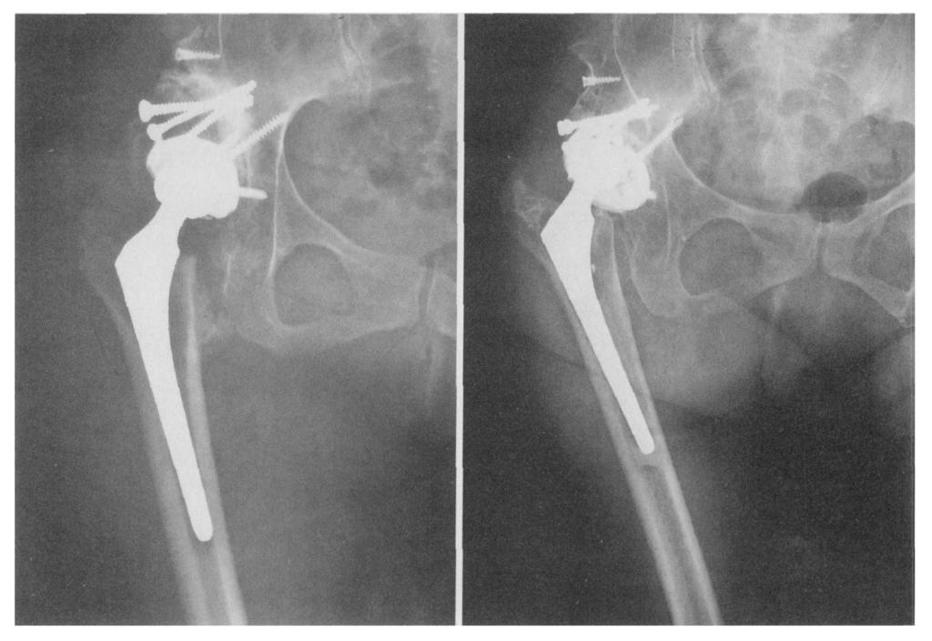 A large portion of the socket is covered by autogenous graft from the femoral head. Fig. 3: Radiograph showing the fractured acetabular shell.