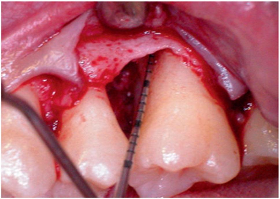 II Intraoperative aspect shows one-wall intrabony defects mesial and distal to the first molar; buccal furcation is only minimally involved (class I).