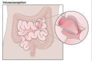 Interruptions of Peristalsis Ileus Lack of peristalsis (intestinal