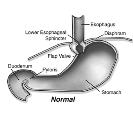 Diseases of the Esophagus Hiatal hernia Protrusion of part of stomach through esophageal hiatus May cause GERD especially