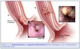 Carcinoma of the Esophagus Esophageal Adenocarcinoma (50%)