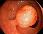 Neoplasms of the Large and Small Bowel Overview Far greater number of neoplasms occur in large intestine than small intestine Colon cancer is 2 nd leading cause of cancer death in US Early detection