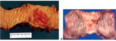 adenocarcinomas (gland-forming) Early lesions are asymptomatic Like adenomatous polyps, about half found in rectosigmoid colon