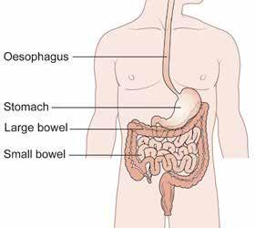 bowel cancer the facts In Ireland, approximately 2,500 people each year develop cancer of the bowel, also known as colon, rectal or colorectal cancer Bowel cancer affects both men and women It is the