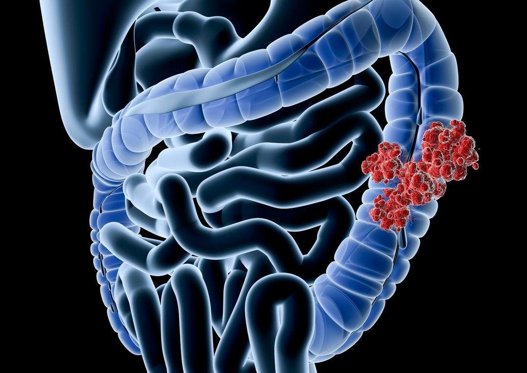 Bowel Cancer in England and Wales A summary report about the management and