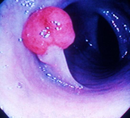 Bowel cancer development Polyps that grows inside
