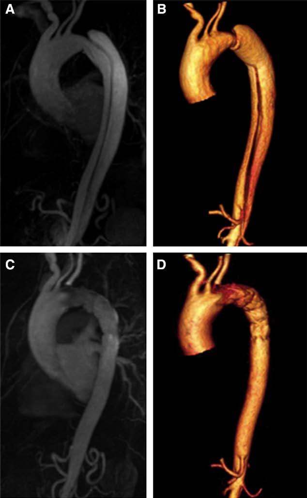 Nienaber et al Long-term F/U After Stent Grafts in Aortic Dissection 413 Downloaded from http://circinterventions.ahajournals.org/ by guest on April 20, 2018 Table 4.