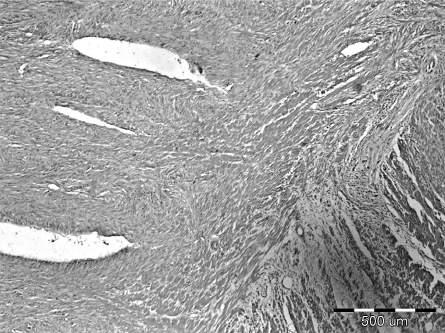 Med Pregl 2015; LXVIII (11-12): 413-417. Novi Sad: novembar-decembar. 415 Figure 2. Leiomyosarcoma arising from tunica muscularis propria of the colon.