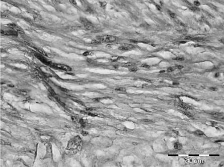 Lejomiosarkom koji potiče iz tunike muskularis proprije kolona. Deo tunike muskularis proprije se može videti u donjem desnom uglu, a neoplazma koja potiče iz nje je prikazana u ostatku slike (H.