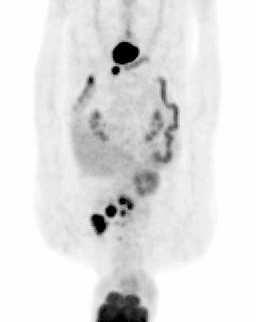 PET and PET/CT Imaging for the Earliest Detection and Treatment 171 peritoneal metastasis. 2 of 14 had no apparent abnormality, but six months later, an adenocarcinoma was discovered at this site.