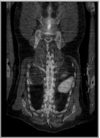 PET and PET/CT Imaging for the Earliest Detection and Treatment 173 Figure 3 - This 70 year old male presented with a history of colon cancer and a rising CEA.