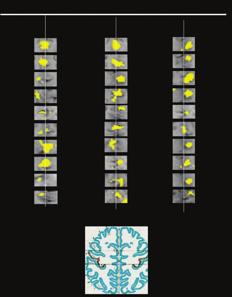 Figure 4. Activity observed within the targeted grid of the medial fronal gyrus is shown (yellow) for each experimental condition (columns) and each subject (rows).