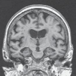 T h e n e w e ngl a nd j o u r na l o f m e dic i n e A B C Figure 2. Coronal MRI Scans from Patients with Normal Cognition, Mild Cognitive Impairment, and Alzheimer s Disease.