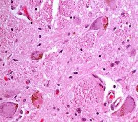 studies 2/3 cases with cerebellar changes 1/3 with Lewy bodies (seen in Parkinson disease) but in