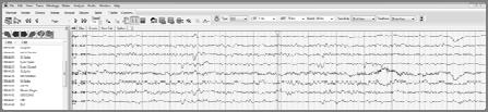 Intrathecal Baclofen Pumps EEG first