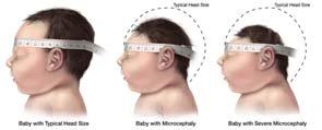 associated with chromosomal syndromes X-linked microcephaly