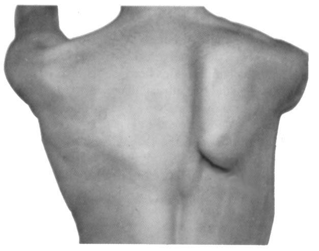 10. The inferior angle of the right scapula of a woman who had undergone a right radical mastectomy protrudes making a ridge beneath the skin of her back.