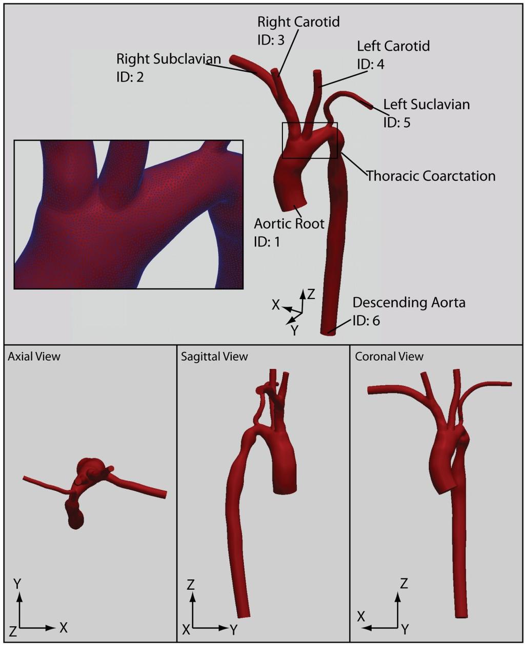 Model Geometry and Physiologic Data The subject was 8-year old female patient with a moderate thoracic aortic coarctation (approximately 65% area reduction) whose body surface area (BSA) was 0.94 m 2.