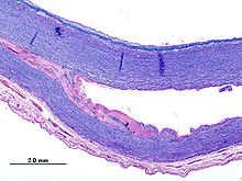 characterized by Smooth muscle cell loss Fragmentation and depletion of elastic fibers