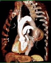Fleischmann Department of Radiology Stanford University Epidemiology / Etiology Surgical anatomy of thoracic aorta