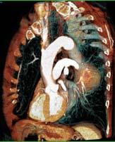 (TAA) (from Greek ανευρυσμα, a dilatation) Incidence: TAA: 6 / 100,000 (<10% of aortic aneuryms) Natural history /