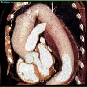 atherosclerotic genetic (congenital wall defect) Bicuspid aortic valve chronic dissection infectious ('mycotic',