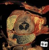 (congenital wall defect) Bicuspid aortic valve aortic root