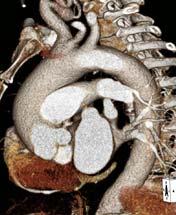 Preoperative and post-operative Aorta: 3D