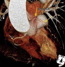 anulo-aortic ectasia (>27) aortic root aneurysm