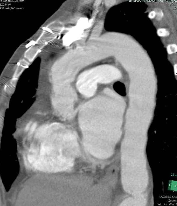 Marfan with prior graft in Asc Aorta Oct 2012