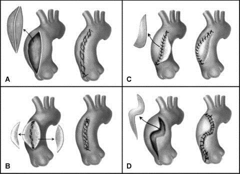 SURGERY Reduction aortoplasty of ascending aortic aneurysms can
