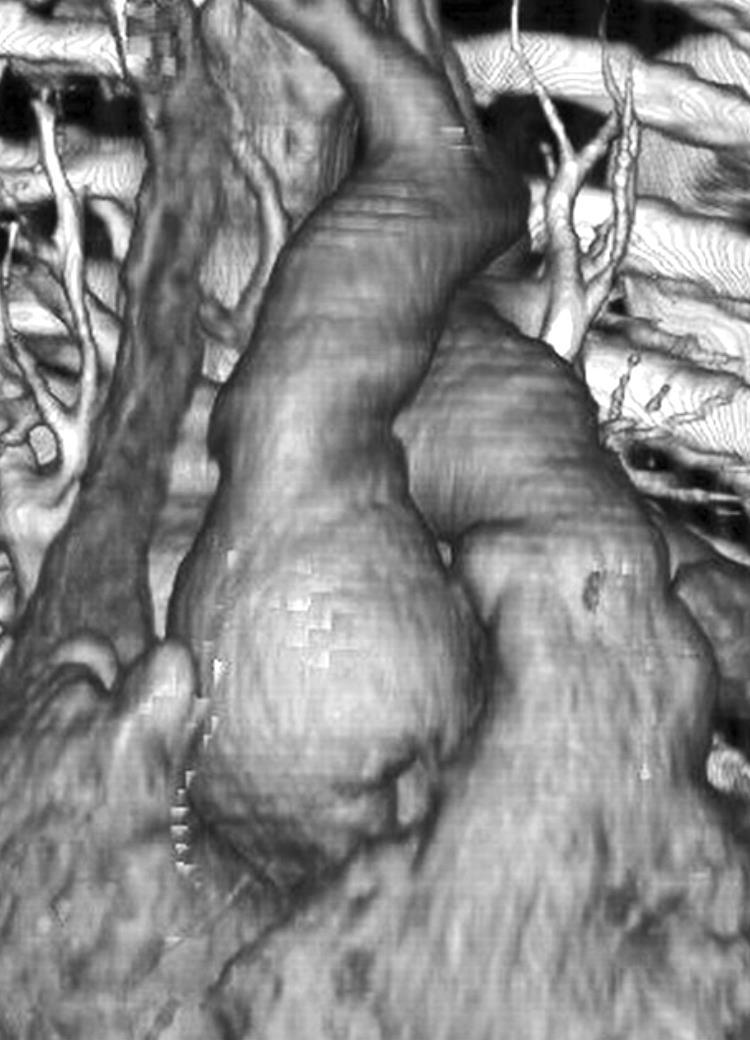 The aortic root may be involved and actually in patients with