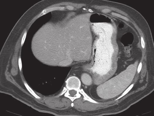 and unexpected gastric metastasis (short arrow).