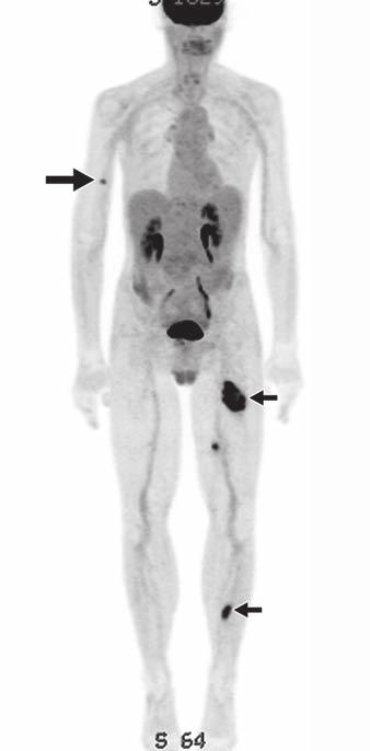 B, Preoperative PET/CT shows three FDG-avid intramuscular masses (short arrows) in left leg, in addition to known right arm metastasis (long arrow). Surgery was canceled.
