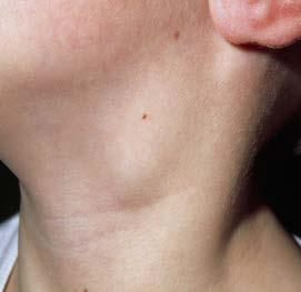 In-transit disease Swollen lymph nodes The type of surgery will be