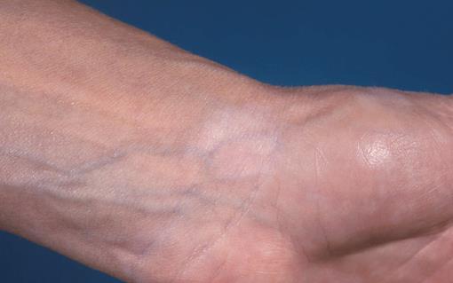 Ipilimumab related vitiligo-like melanomaassociated hypopigmentation (MAH) asymptomatic possibly portends