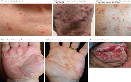 Anti PD-1/PD-L1 related lichenoid dermatitis 75% with pruritus Variable time of onset (mean 4 mos) delayed compared to ipi Variable clinical presentation (even in same patient) Pathology strikingly