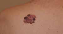 Distinct Melanoma Subtypes Arising from Skin Without Chronic Sun Damage 60% BRAF