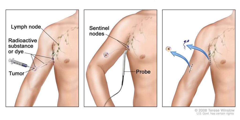 Sentinel Lymph Node (SLN) Biopsy SLN Biopsy is a staging procedure that allows for the detection of microscopic