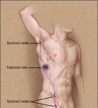 taken up by lymph nodes, mimicking the path of tumor spread.