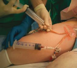 Isolated limb infusion ILI is a technique is a less invasive method for administering regional therapy by a percutaneous approach not requiring a