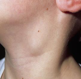 disease Swollen lymph nodes The type and extent of surgery will be
