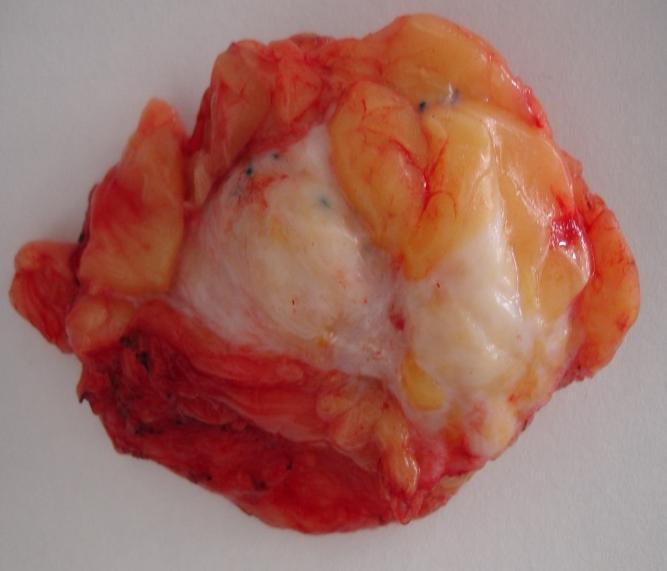site of tumor /tumors may be especially difficult