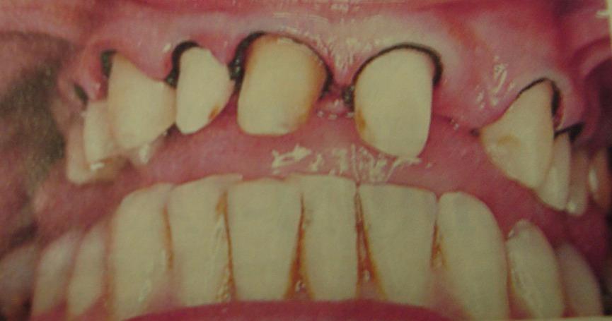 This will lead to shrinkage of the gingival tissue and control the fluid seepage from the gingival sulcus.