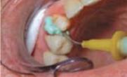 Unfortunately, gingival retraction cord may injure the gingival sulcular epithelium and the gingival bleeding is difficult to control
