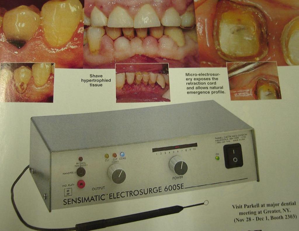 4 Electro-surgical: In this technique, an electro-surgical unit could be used to remove the gingival tissue from the area of the finishing line with the advantage of controlling the postsurgical