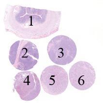 Assessment Run 5 207 Lung Anaplastic Lymphoma Kinase (lu-alk) Material The slide to be stained for lu-alk comprised:. Appendix, 2. Tonsil, 3. Merkel cell carcinoma, 4.